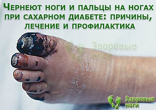 Если у вас чернеют ноги при сахарном диабете, то вам нужно знать причины это вызывающее