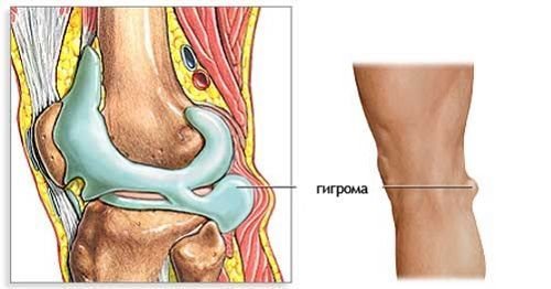 Фото гигрома на колене