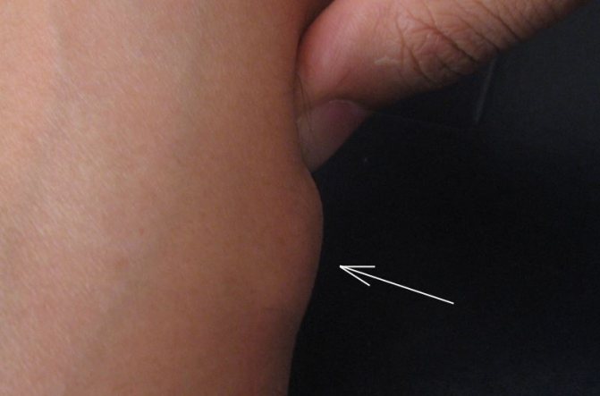 Гигрома на локтевом суставе