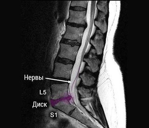 Грыжа дисков L5-S1 на снимке