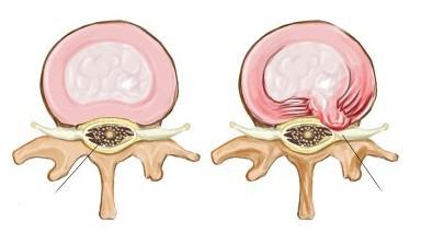 грыжа межпозвоночного диска l5 s1