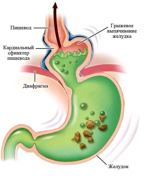 Грыжа желудка
