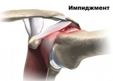 Импиджмент-синдром