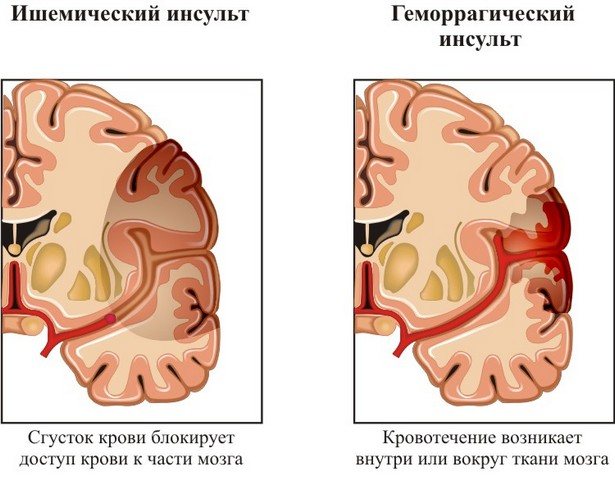 Ишемический и геморрагический инсульт