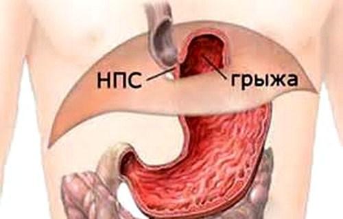 Изображение грыжи желудка