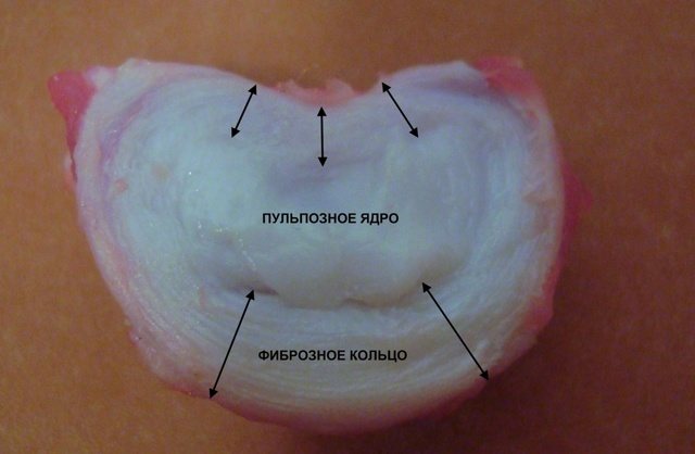 К какому врачу обращаться при грыже позвоночника