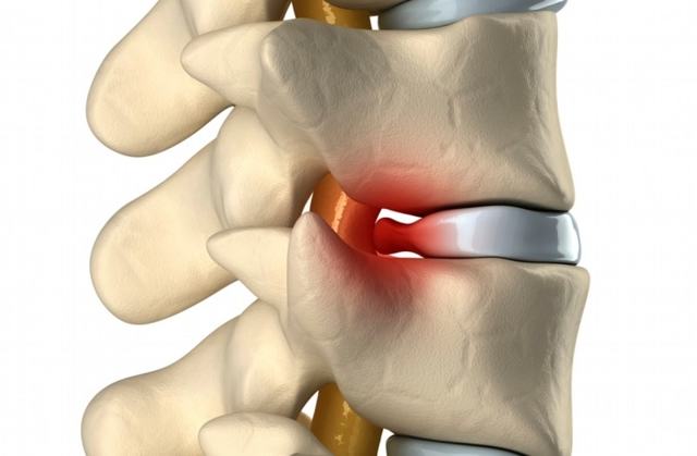 К какому врачу обращаться при грыже позвоночника