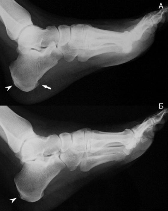 как лечить пяточную шпору медикаментозно