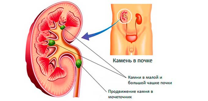 Камни в почках