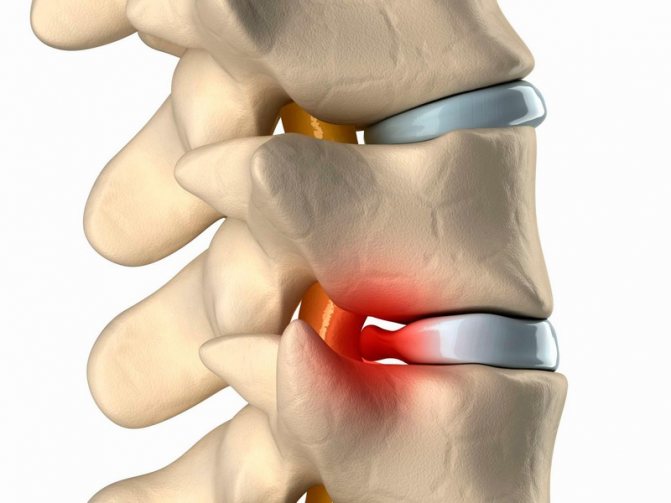 когда необходимо делать блокаду позвоночника