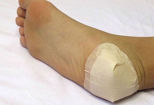 Компресс на пятке