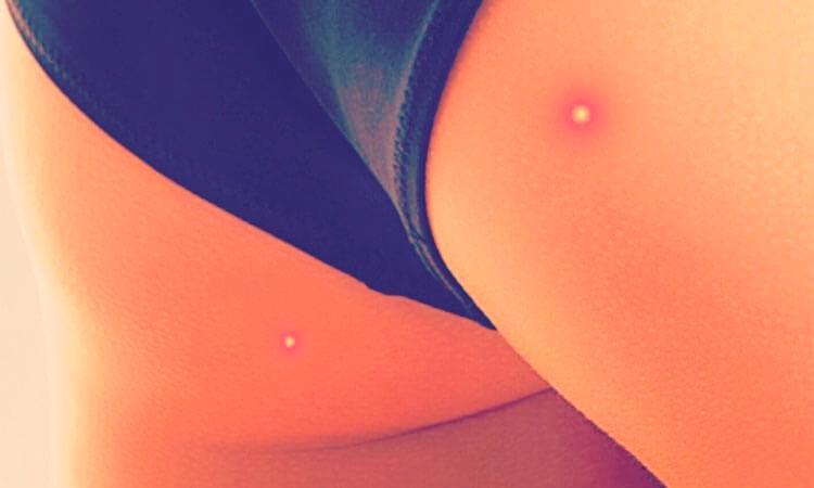 Красные точки на бедрах и шишки на ягодицах