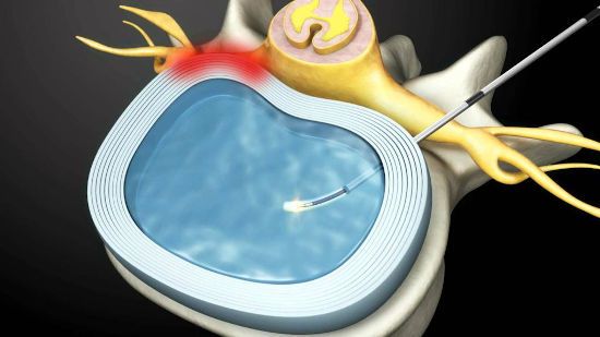 Лазерная валоризация