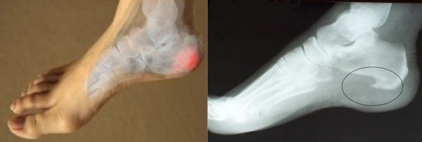 Лазерное лечение пяточной шпоры: что нужно знать перед началом лазерной терапии