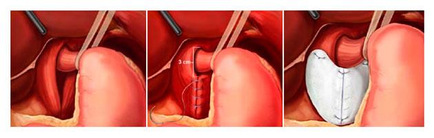 Лечение грыжи желудка хирургическим путем