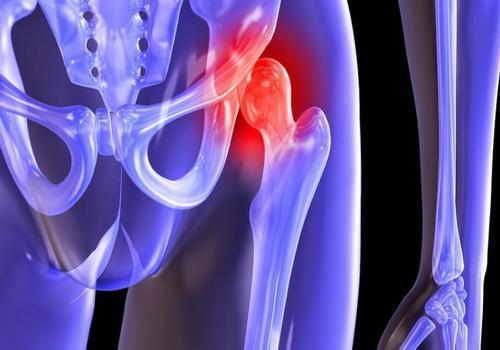 Лучшие обезболивающие при коксартрозе тазобедренного сустава: что можно и что нельзя