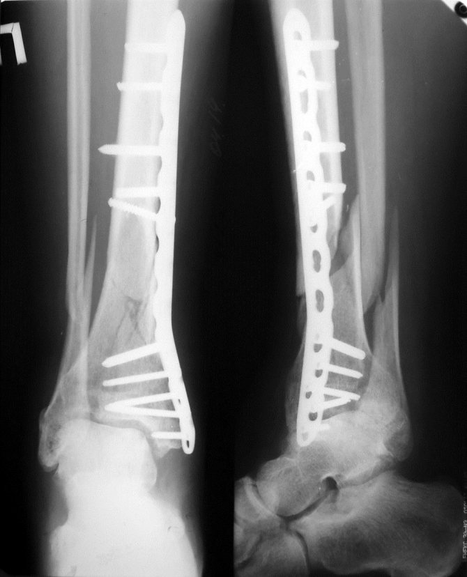 Металлоостеосинтез большеберцовой кости пластиной