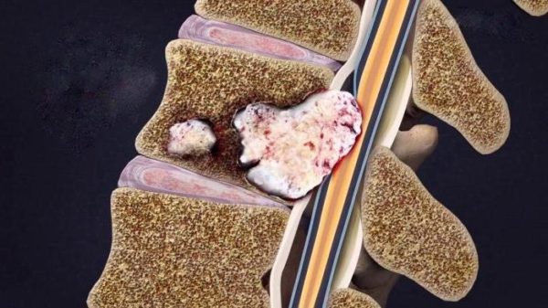 Метастазы в позвоночник