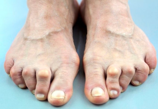 молоткообразная деформация пальцев стопы