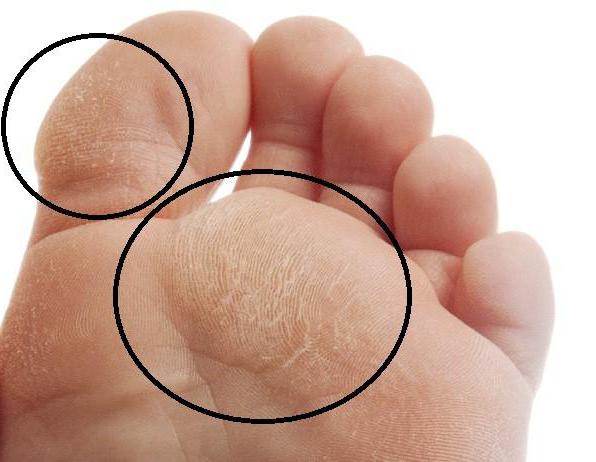 молоткообразный палец операция