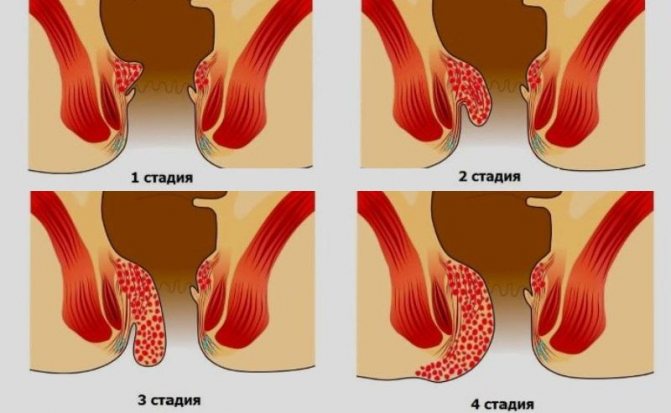 Может ли при геморрое болеть низ живота и поясница