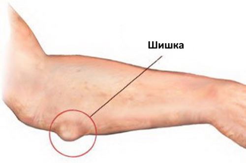 На фото внешний вид гигромы локтевого сустава.