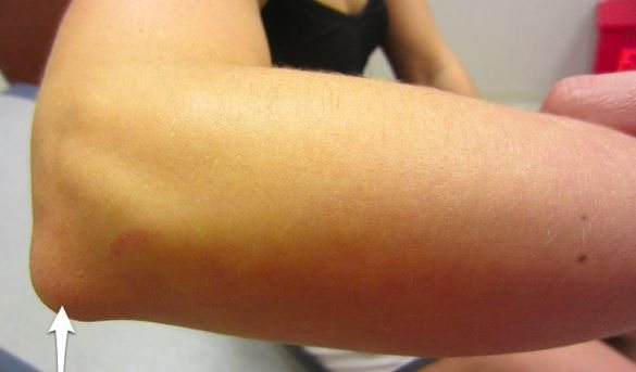 На изображении гигрома локтевого сустава