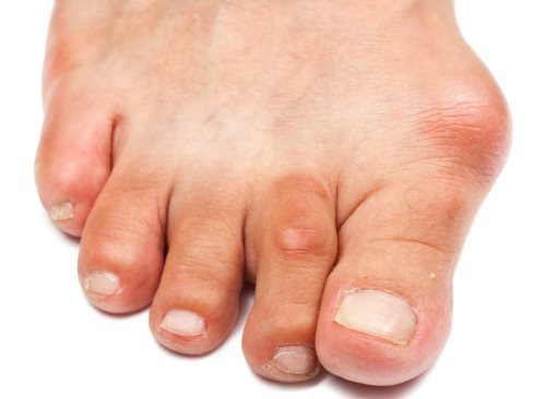 На изображении гигрома на пальце ноги