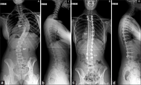 Обратите внимание как выглядит позвоночник на рентгене до и после операции