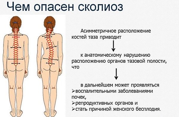 Обратите внимание на последствия сколиоза