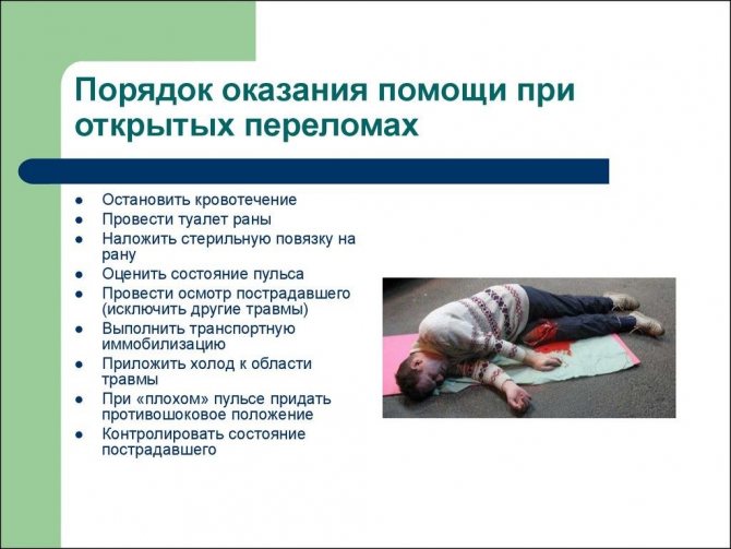 Оказание первой помощи при переломе бедра и последствия