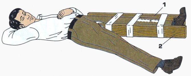 Оказание первой помощи при переломе бедра и последствия