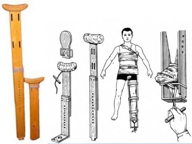 Оказание первой помощи при переломе бедра и последствия