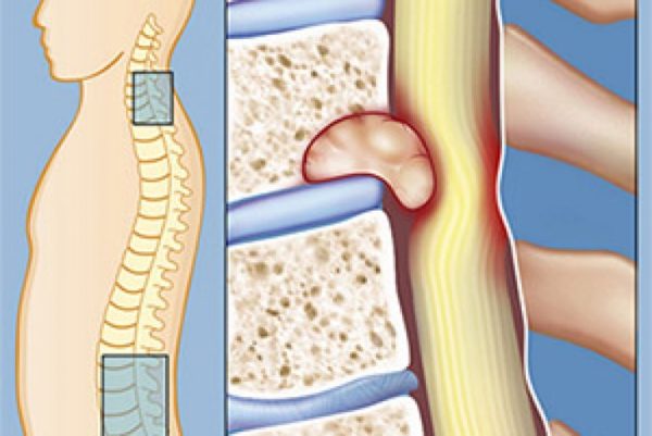 Опухоли позвоночника
