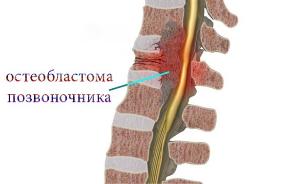 Остеобластома позвоночника