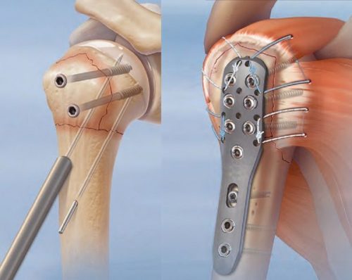 Остеосинтез для сращивания костей