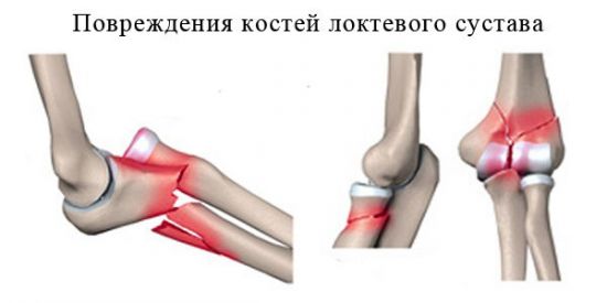 Перелом локтевой кости