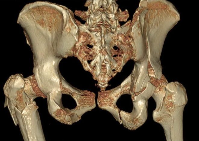 Перелом лонной кости на на компьютерной томографии