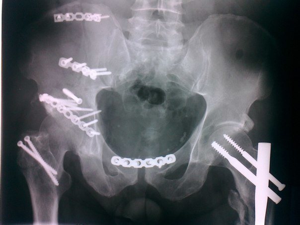 Перелом лонной кости таза лечение