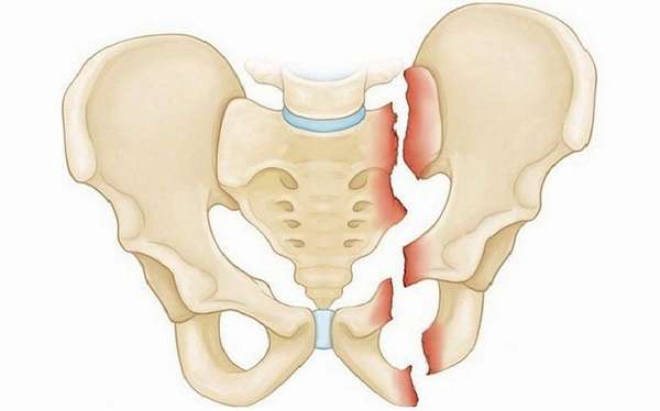 Перелом лонной кости таза лечение