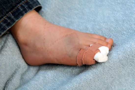 Перелом мизинца