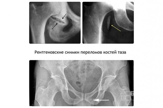Перелом седалищной кости на снимке УЗИ