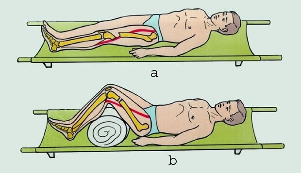 Первая помощь при переломе бедра: оказание медицинской помощи при переломах шейки бедра