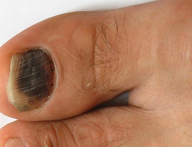 Почему побелел ноготь на большом пальце ноги