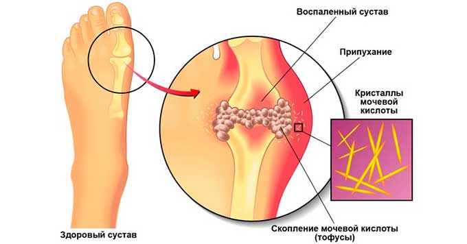 Подагра сустава на ноге