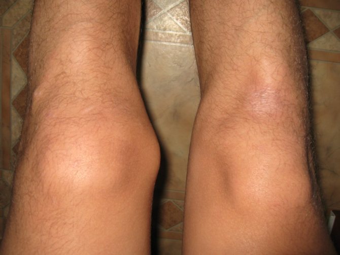 Пораженное колено