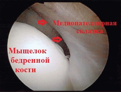 Повреждение медиопателлярной складки коленного сустава