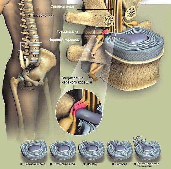 Поясничный отдел позвоночника наиболее уязвимый для развития грыж
