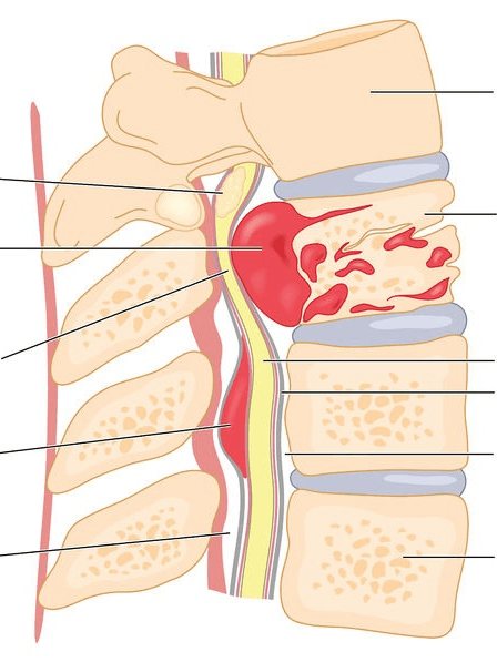 Припухлость на спине