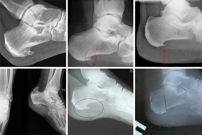 Признаки Шпоры на снимке